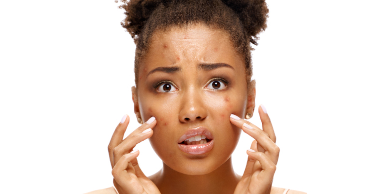 Mujer con acné hormonal
